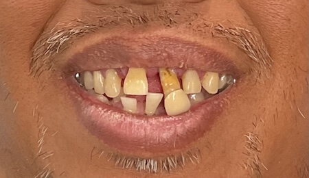 Dental Implants Before