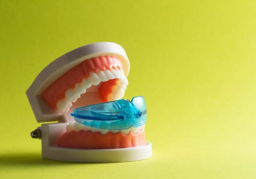 Mouth with teeth nightguard.