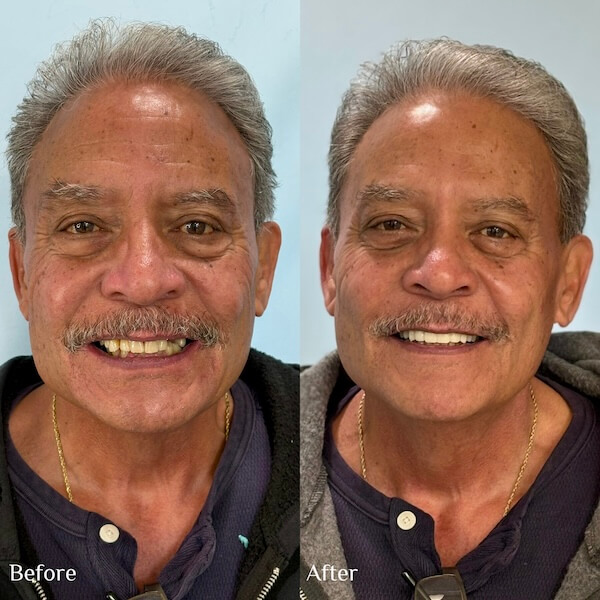 Teeth in a day 1